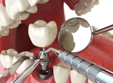implant diş tedavisi